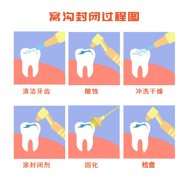 兒童窩溝封閉過程圖