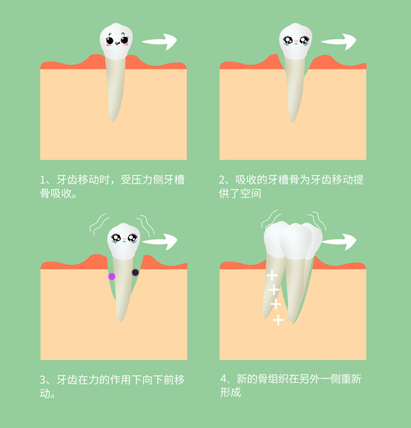 戴牙套矯正牙齒的流程