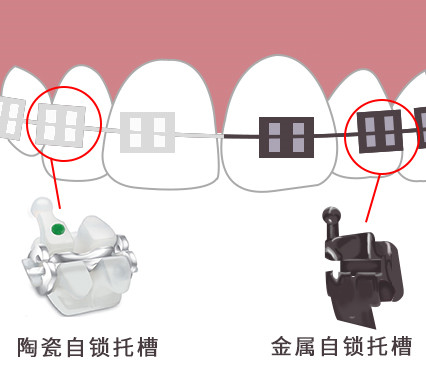 自鎖托槽矯正牙齒