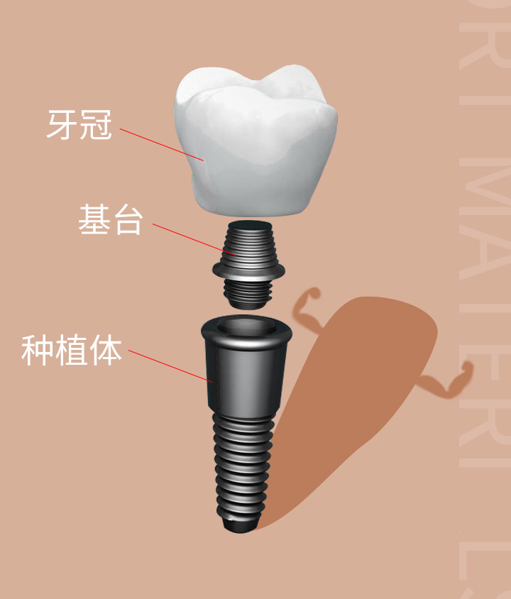 種植牙結(jié)構(gòu)圖